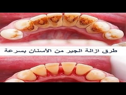 تبيض الاسنان - خلطات لازالة الجير 5692