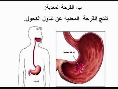 ما هي امراض الجهاز الهضمي - وعاء الشر 570 2