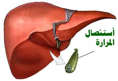 سعر عملية المرارة بالمنظار , عمليه المراره وتكلفتها الماديه