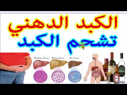 اعراض تشحم الكبد , طرق علاج تشحم الكبد