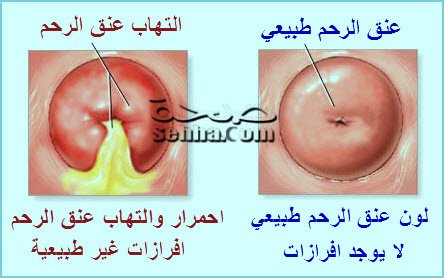 اعراض جرح عنق الرحم - التهابات عنق الرحم واشهر طرق العلاج 6830 1