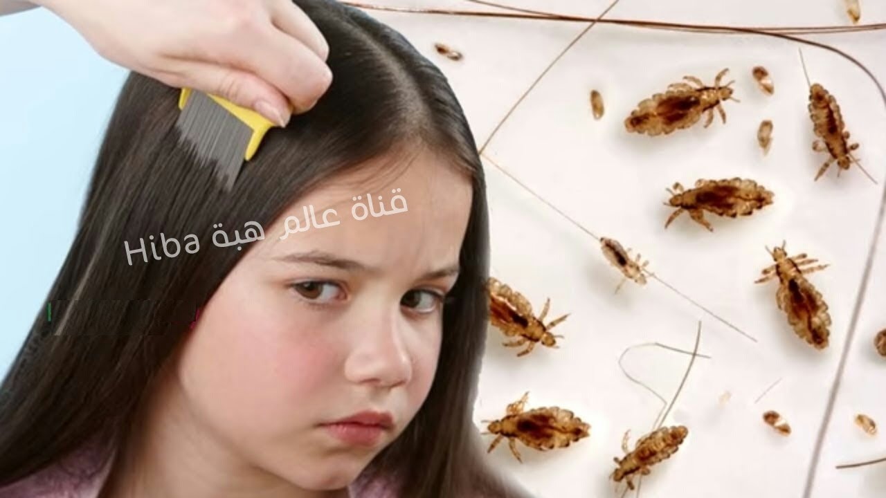 طريقة التخلص من القمل