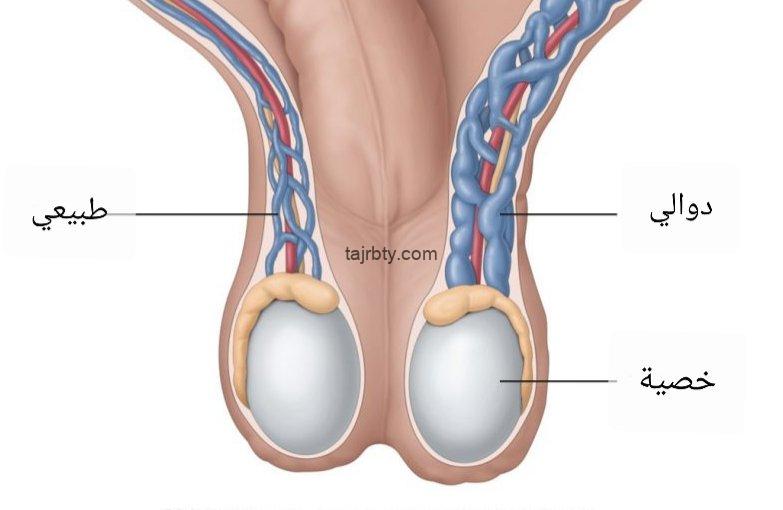 تجربتي دوالي الخصية , ابدء فى العلاج بارادة