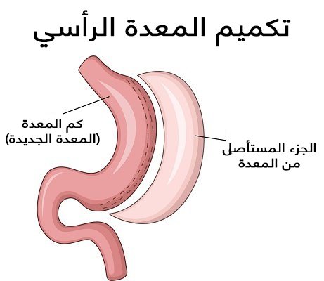 تكلفة عملية بالون المعدة في مصر/اهمية بالون المعدة 5395 2