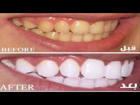 6925 1 افضل واسرع طريقة لتبيض الاسنان - ابسط واجمل الوصفات لتبيض اسنانك نقاء علي