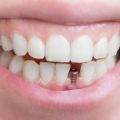 17112 1 دكتور زراعة اسنان بالرياض - حافظ على اسنانك كاملة نقاء علي